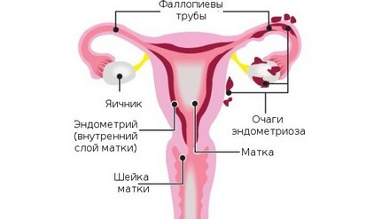 bolovi u zglobovima s endometriozom)